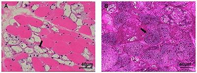 Case Report: Identification of Compound Heterozygous Mutations in a Patient With Late-Onset Glycogen Storage Disease Type II (Pompe Disease)